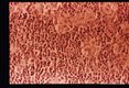Toxoplasma lymphadenitis with lymphoreticular hyperplasia. H&E stain.