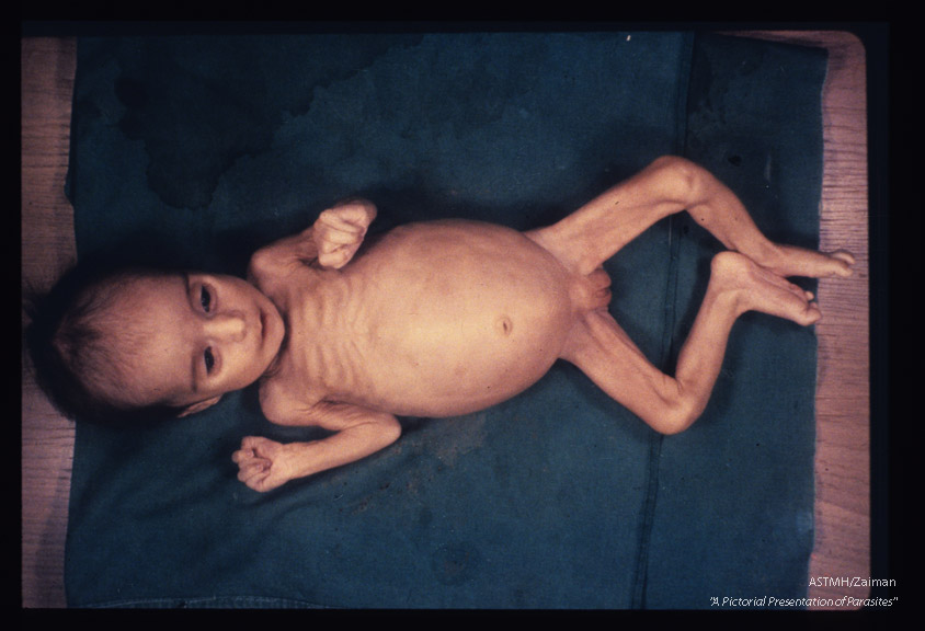 Premature infant who died of pneumonia four months after birth. Note the total marasmus, the rachitic rosary, protruding abdomen and severe muscle wasting.