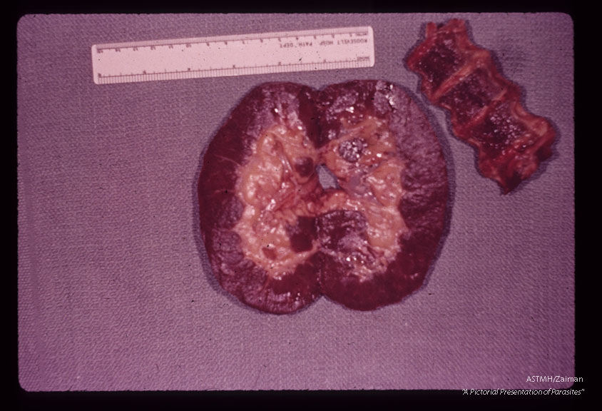 A 69 year old white male received 10 pints of blood shortly before,  during and after gastrectomy for a   benign gastric ulcer.    One of the donors,  a previously infected veteran of the Viet Nam war, registered at the blood bank under a false name and addrer Approximately four weeks after the surgery the patient developed a fatal case of falciparum malaria.  The deep brown color of kidney and bone marrow are indicative of pigment deposition.