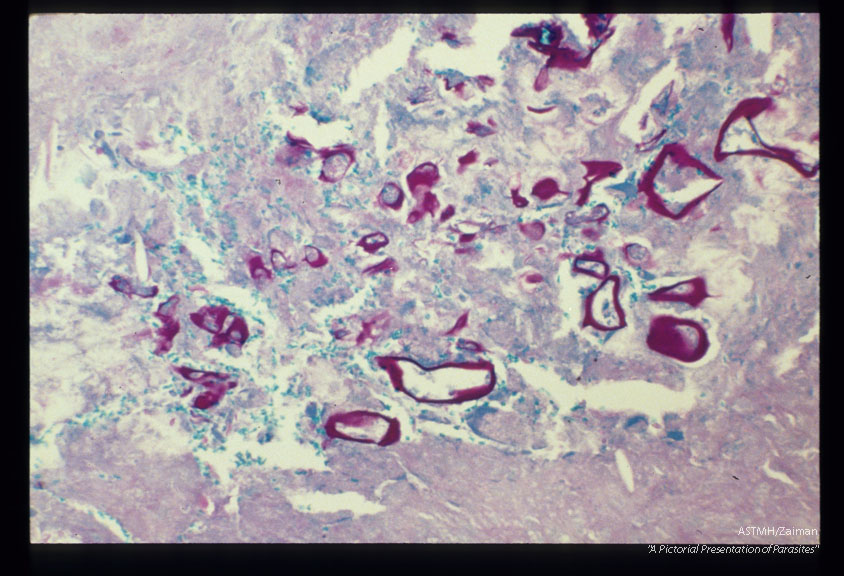 PAS stain of infected human liver.