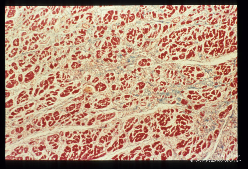 Cardiac muscle showing parasites, inflammatory response, loss of myocardial fibers and fibrous replacement.