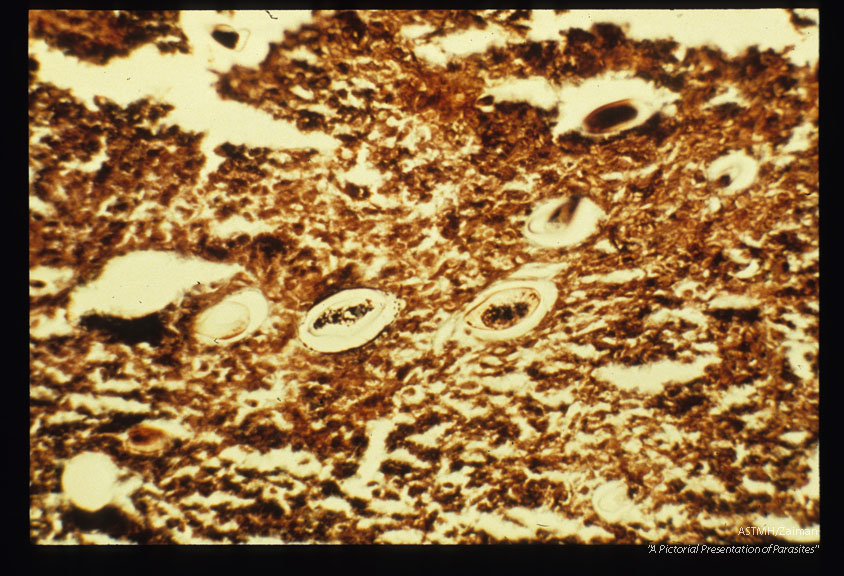 Low and high power views of eggs in necrotic granulomatous pelvic lesions. The patient was a young female who suffered chronic dysrnenorrhea, dyspareunia and lower abdominal discomfort. Silver methenamine stain.