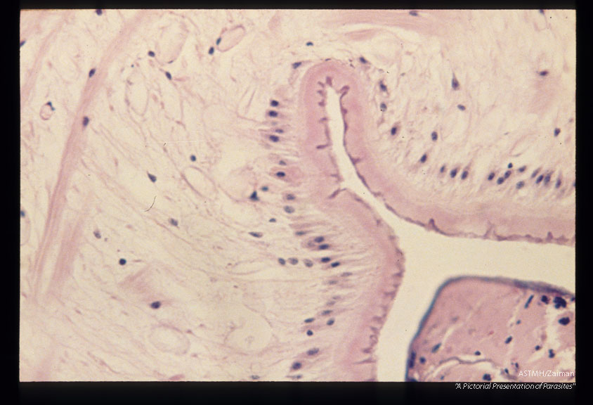 Multiple sections through subcutaneous human tissue containing a sparganum and through the sparganum itself. Note the tremendous inflammatory reaction.