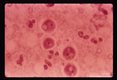 Lee case of primary amoebic meningo encephalitis. Olfactory bulb smear 3 August. Hematoxylin stain.