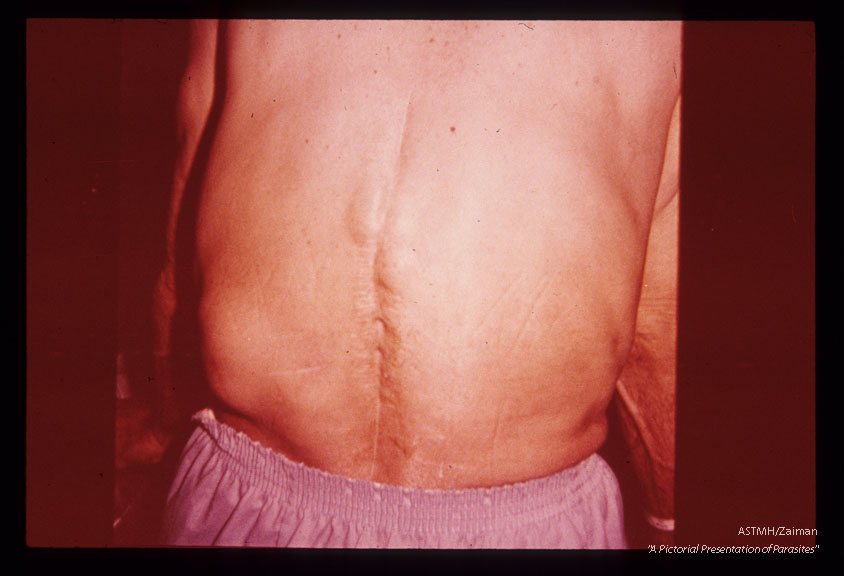 Posterior view showing scars of previous surgery, the large cyst in the left flank and several smaller ones near the upper end of the scars.