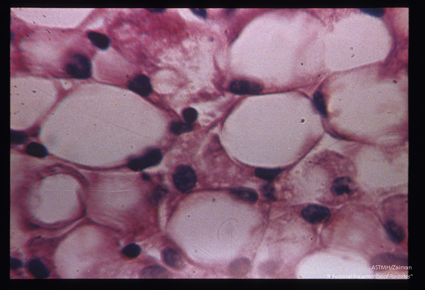 Hematoxylin-eosin stained section of above liver showing fatty degeneration of parenchymatous cells.