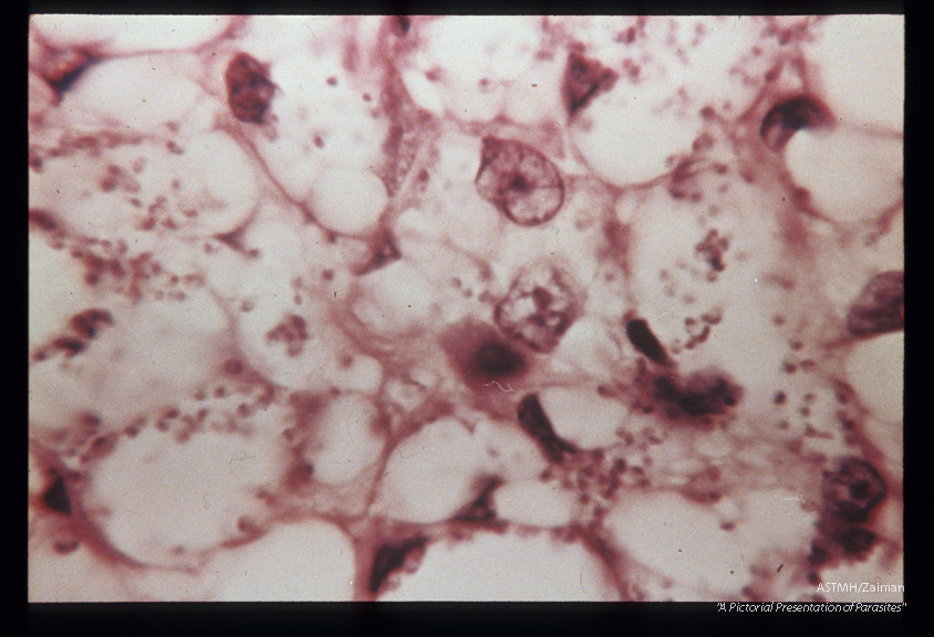 (South America), Hematoxylin-eosin stained section of pseudo-lepromatous lesion showing Leishmania.