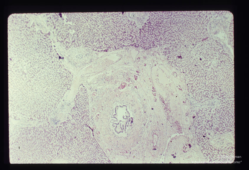 Human liver showing periportal fibrosis due to worms in biliary ducts.