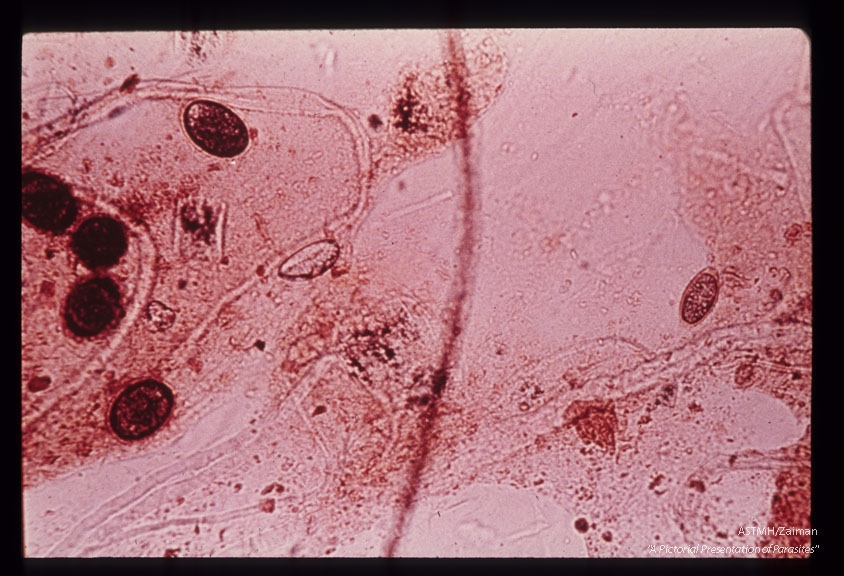 Eggs demonstrated on a single scotch tape preparation taken from an eight year old caucasion female living on isolated rural non-farm land in northern West Virginia. This slide clearly demonstrates that eggs other than Enterobius, may be picked up by the scotch tape technique.