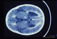 Samecase. Contrast enhanced CT brain scans show ventricular dilatation, periventricular enhance­ment and enlargement of cortical sulci.