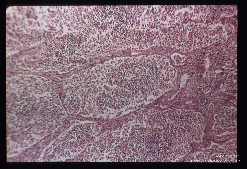 Hematoxylin-eosin stained sections of lymph gland showing adenitis associated with infection.