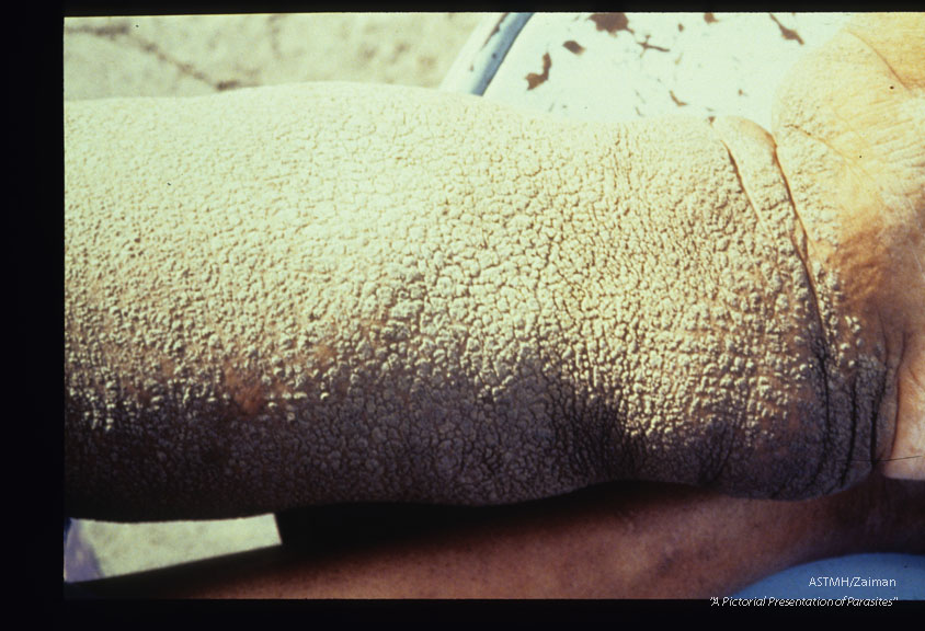 Heavy cobblestone hyperkeratosis and elephantiasis of the left leg of a forty-four year old female. Case was acquired thirty-two years earlier.
