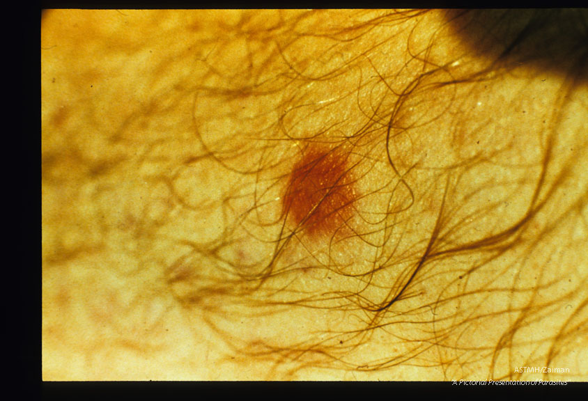 Skin reaction to a chigger bite of the leg (Missouri).