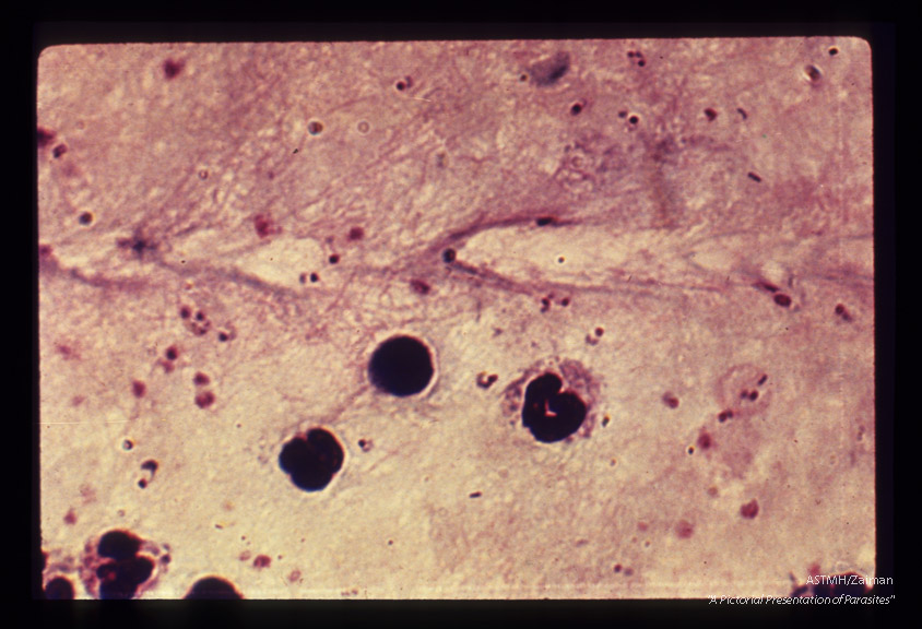 Thick smear. The ring stages appear as small dots to which an apron of cytoplasm is attached more or less firmly.
