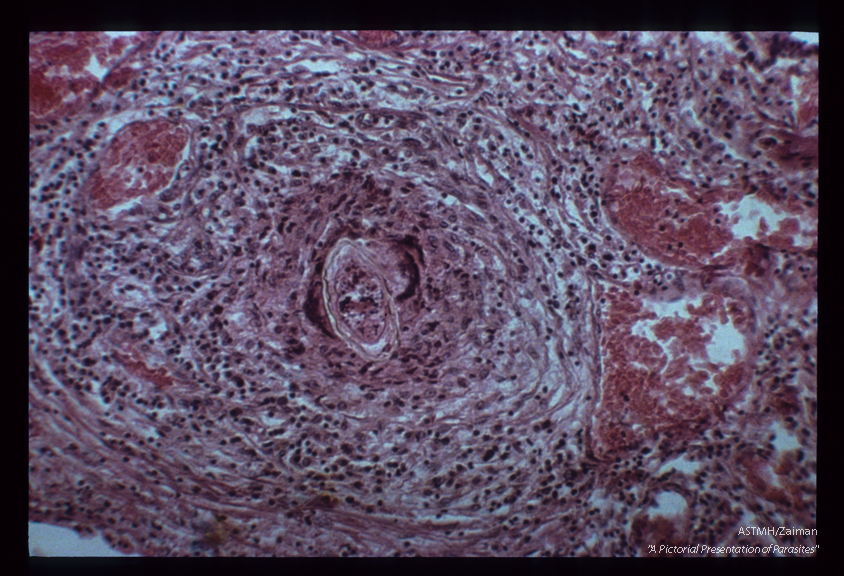 Granuloma around egg in human lung. The egg shell is clearly visible in the center of the fibrosing granuloma. Especially noteworthy are the blood filled angiomatoids.