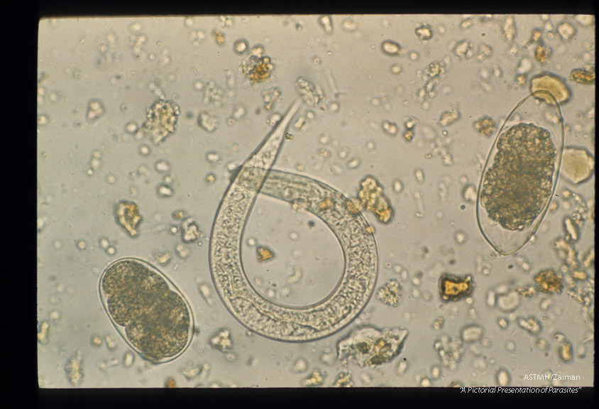 Trichostrongylus egg, and Strongyloides stercoralis larva. All from one patient.