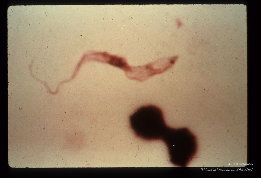 A seventy-one year old white male,  with a history of malaria 40 years earlier,  complained of weakness of three weeks duration following a vacation trip through Botswana,  South Africa in July and August of 1971.    During that trip he suffered many insect bites.    In September because of malaise,  chills and fever,  he started taking quinine.    A local physician subsequently prescribed quinine and Daraprim.    The chills and fever abated but weakness persisted. He became anorectic and lost weight. Physical examination in New York (Dr.  Hoskins) was remarkable for lethargy,   mild cnoephalopathy on HIP testing but no localizing signs,  bilateral,  cervical,  axilary and inguinal lymphadenopathy. Laboratory examination revealed slight anemia,  and motile trypanosomes in the; peripheral blood     The spinal fluid was clear,  opening pressure 130mm.   H2O,  4RBC,   33WBC, 84% mono,   16% sugar,   58% protein.    Twenty eight motile trypanosomes   / mm3 were seen in the counting chamber. The patient was treated with Suramin and Mel B (Arsobal) . The parasitemia disappeared,  the CSF cleared.    The patient probably suffered a transient reaction to Mel B (AS1)   with muscle weakness,  proximal more than distal with decreasing vibratory sense and fine tremor.  Higher power view of trypanosome in spinal fluid of same patient.
