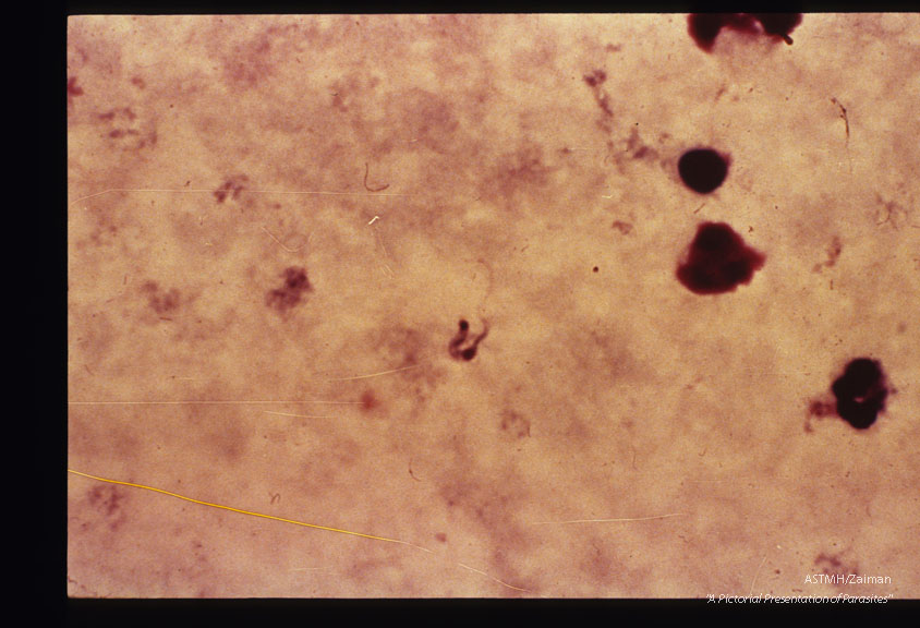 Thick smear of human blood containing a parasite.