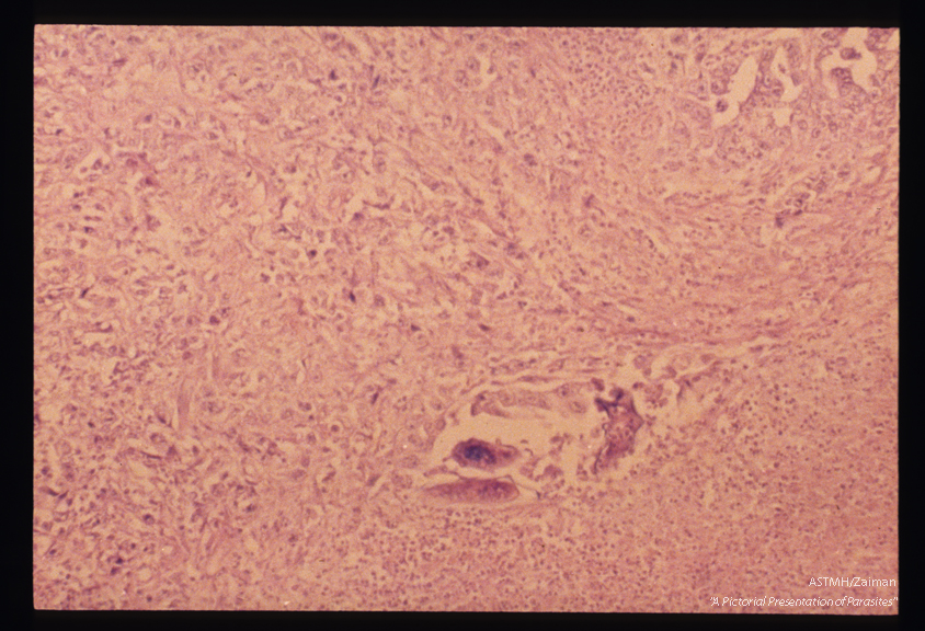 Eggs in an adenocarcinoma of the rectal mucosa. The ova are more deeply stained than the surrounding tumor.