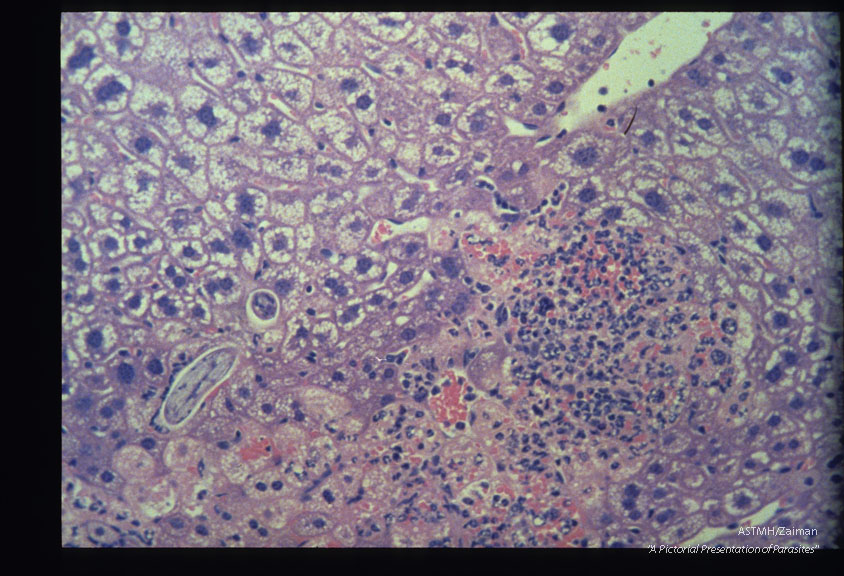 Mouse, BALB/c-Experimental infection as in 1955 Liver. At 48 hours PI this coiled larva, seen in both longitudinal and cross section, is not directly associated with the inflammatory response. HE, x 400.