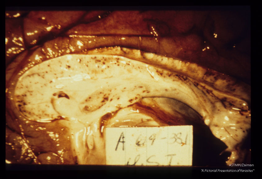 Heavily pigmented brain showing multiple punctate hemorrhages in the septum pellucidum.