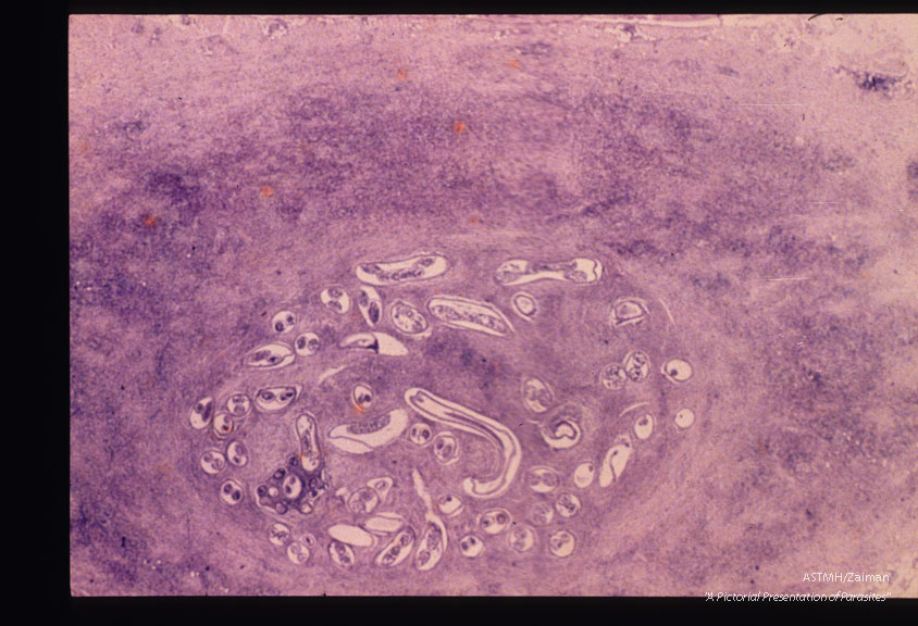 Nodule showing considerable host inflammatory response around the adult worms.