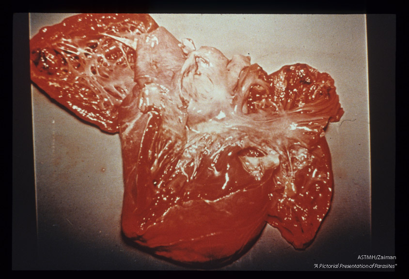 Gross pathology. Opened heart showing myocarditis in Chagas' disease.
