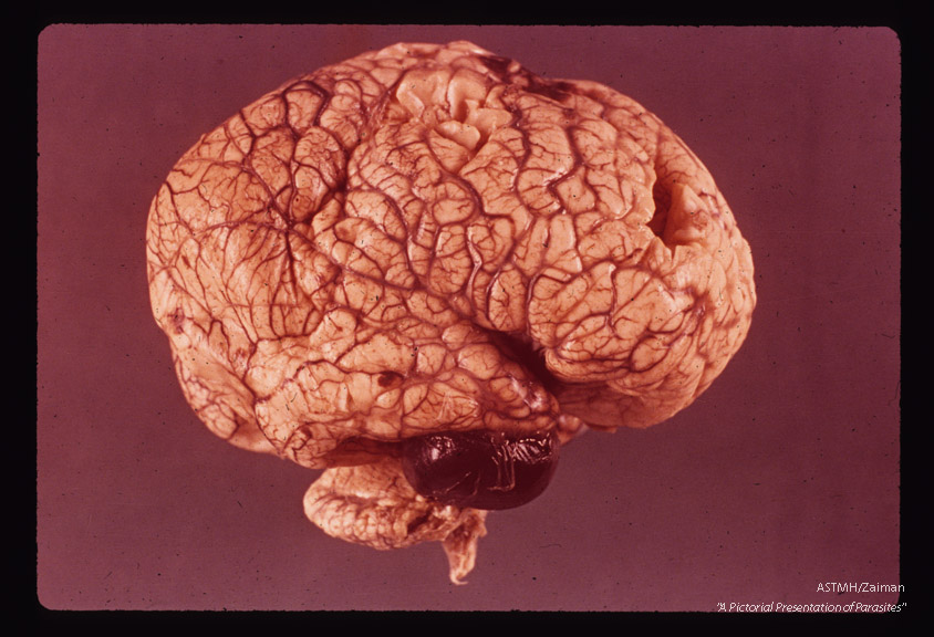 Formalin fixed hydrocephalic infant brain showing hemorrhage, congestion and pressure.