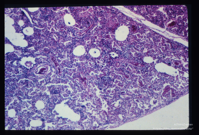 Pneumonia. Low power view of lung (infant) showing that not all alveoli contain "honeycomb material".