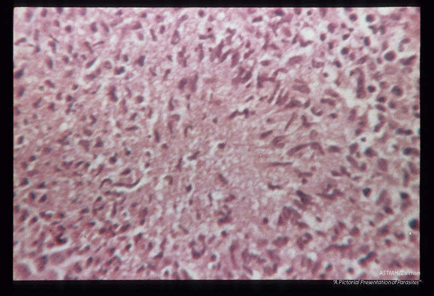 (South America). Hematoxylin-eosin stained tissue section showing tuberculoid (granulomatous) reaction with central necrosis but no parasites.