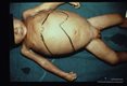 Child with liver abscess at autopsy.