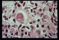 Microscopic views of amebae in skin lesion.