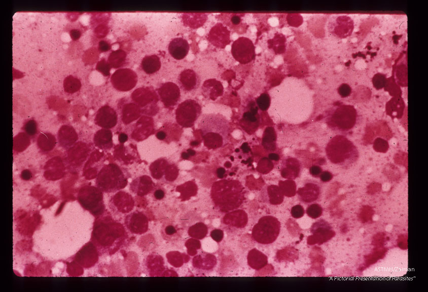 A 69 year old white male received 10 pints of blood shortly before,  during and after gastrectomy for a   benign gastric ulcer.    One of the donors,  a previously infected veteran of the Viet Nam war, registered at the blood bank under a false name and addrer Approximately four weeks after the surgery the patient developed a fatal case of falciparum malaria.  Malarial pigment in microscopic section of bone marrow.