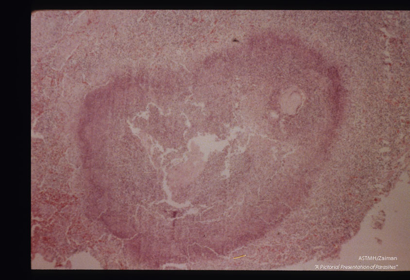 Fragments of adult in necrotic focus within lung (fatal pulmonary schistosomiasis.)