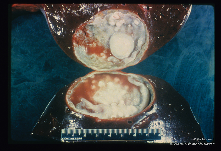 Cyst in liver. A young male died of unknown cause on his honeymoon. At autopsy his liver showed an intact well encapsulated hydatid cyst. The spherical cyst has been hemi-sected. The halves are seen side by side. The cyst wall is retracted from the liver at some points. Daughter cysts and brood capsules may be seen. The red material within the cyst is blood which accumulated there following dissection.