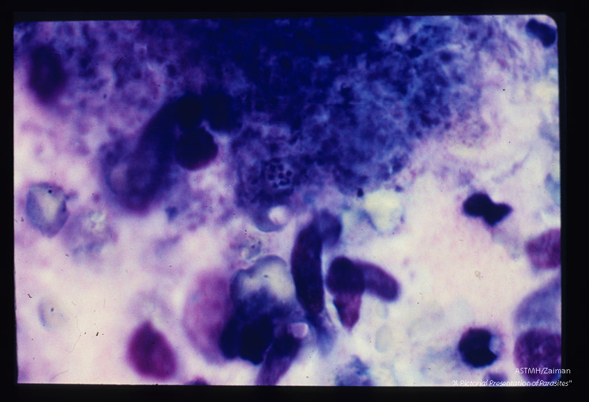 Pneumonia. Oil immersion view of alveolar material colored by Romanowsky type stain showing cyst like structures containing up to eight parasites.