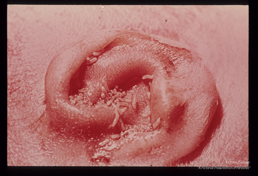 Myiasis. Premature infant died shortly after birth. Numerous first stage larvae were present in the ear. Similar larvae were recovered from the mothers vulva. Efforts to rear maggots were unsuccessful.