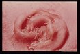 Myiasis. Premature infant died shortly after birth. Numerous first stage larvae were present in the ear. Similar larvae were recovered from the mothers vulva. Efforts to rear maggots were unsuccessful.