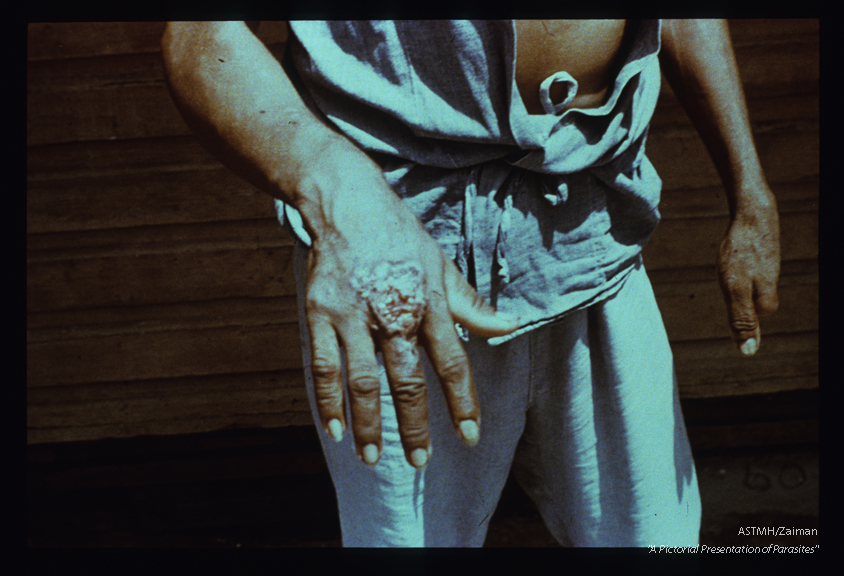 (Costa Rica). Ulceration of hand.