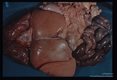 Gross pathology. Fatty degeneration of human liver associated with infection.