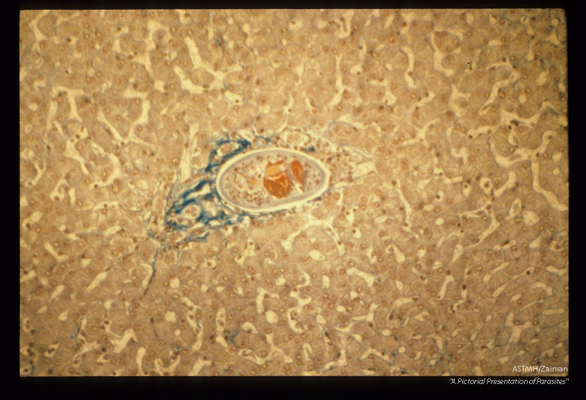 Mesocercaria in the liver. Martin's scarlet blue stair.