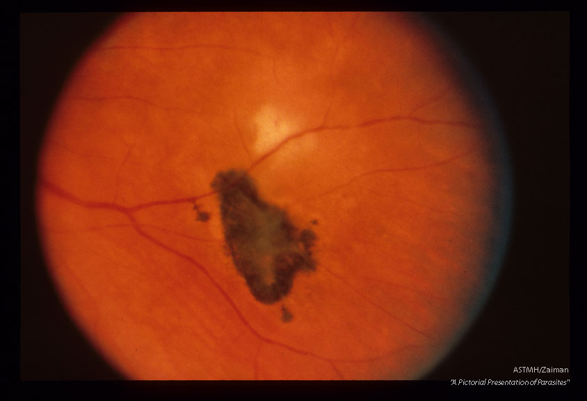 Retina showing an active and an old lesion.
