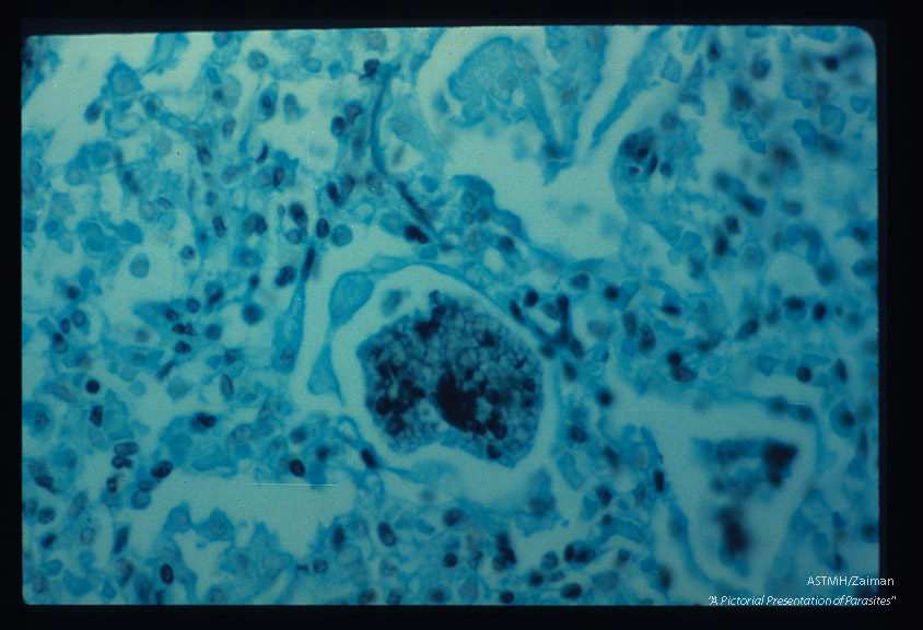 Pneumonia. Higher power views of infected lung stained with silver methenamine. Darkly stained parasites within the "honeycomb" material occasionally contain stained nuclear material.