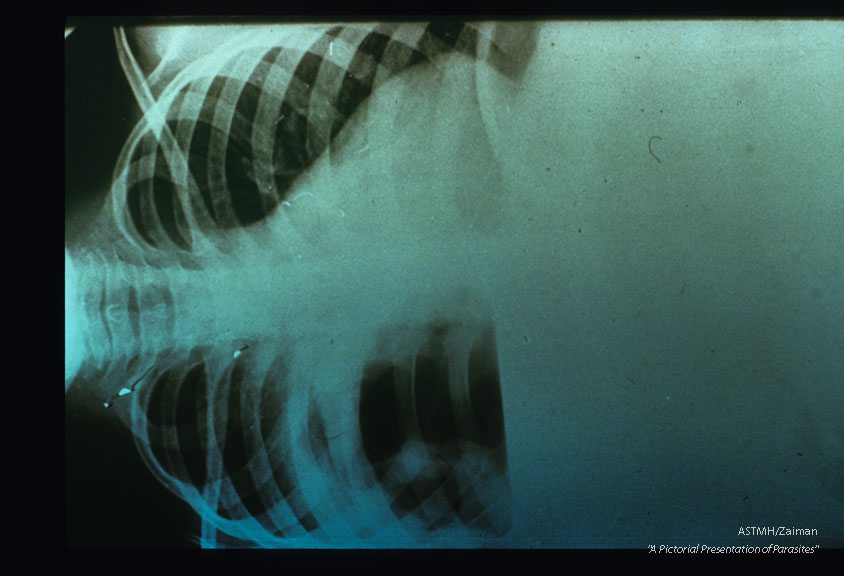 X-ray showing liver abscess with elevated right diaphragm and fluid level.