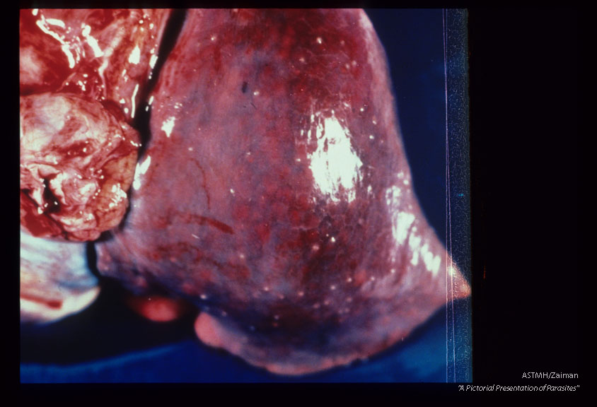 Same case. Multiple subpleural granulomas in lung.
