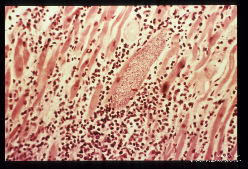 Section of myocardium showing numerous parasites, edema, and inflammatory infiltrate.