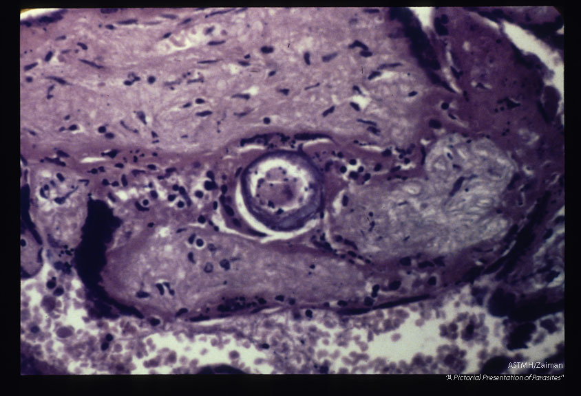 Schistosomal placentitis. An egg is present among the villi. Note disappearance of the trophoblastic epithelium.