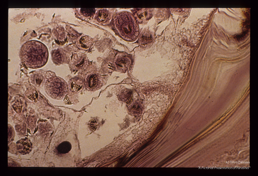 Cyst in lung showing the laminate and proliferative layers. Daughter cysts contain scolices many of which have degenerated as evidenced by the presence of free hooks.