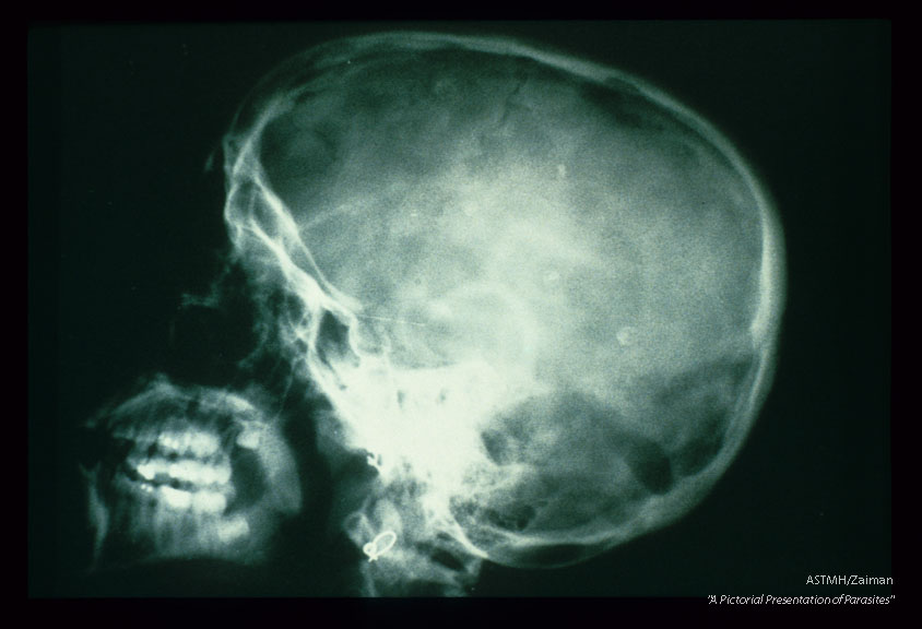 A lateral view of the skull shows multiple small amorphous punctate white calcific masses in the brain. These are calcined cysticerci. Some of these lesions are remarkable for presenting in a target-like configuration. The outer line represents calcification of the bladder wall. The inner dot is the calcified scoiex. The dark area surrounding the scolex is fluid.