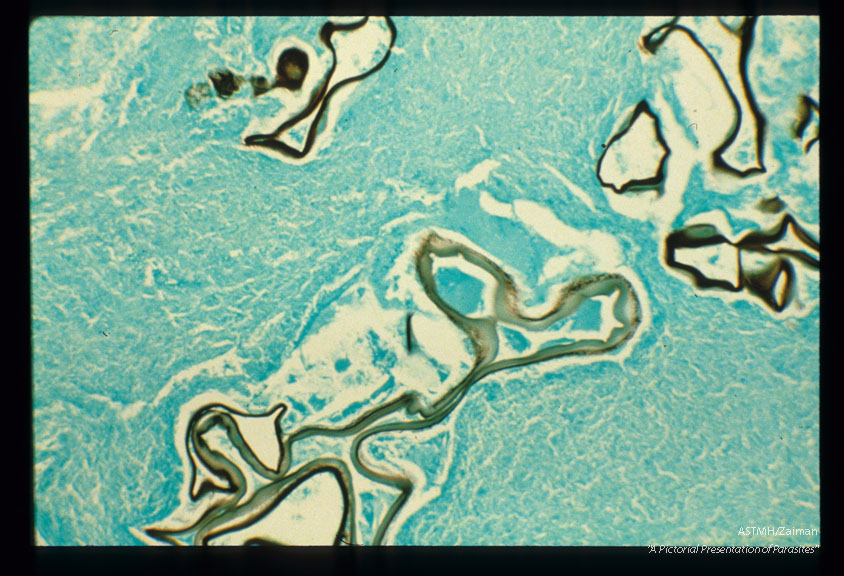 Silver methenamine stain of infected human liver.